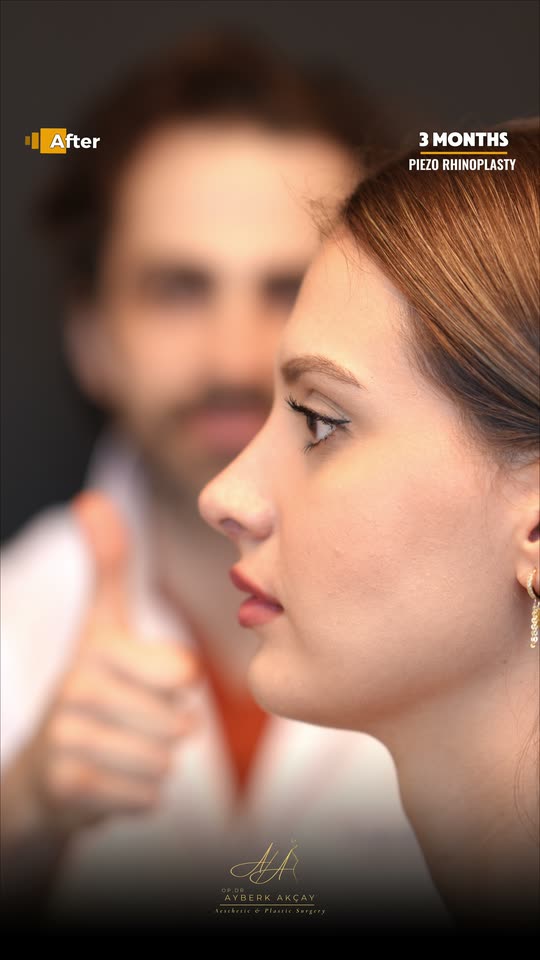 Rinoplasti sonrası profil görüntüsü