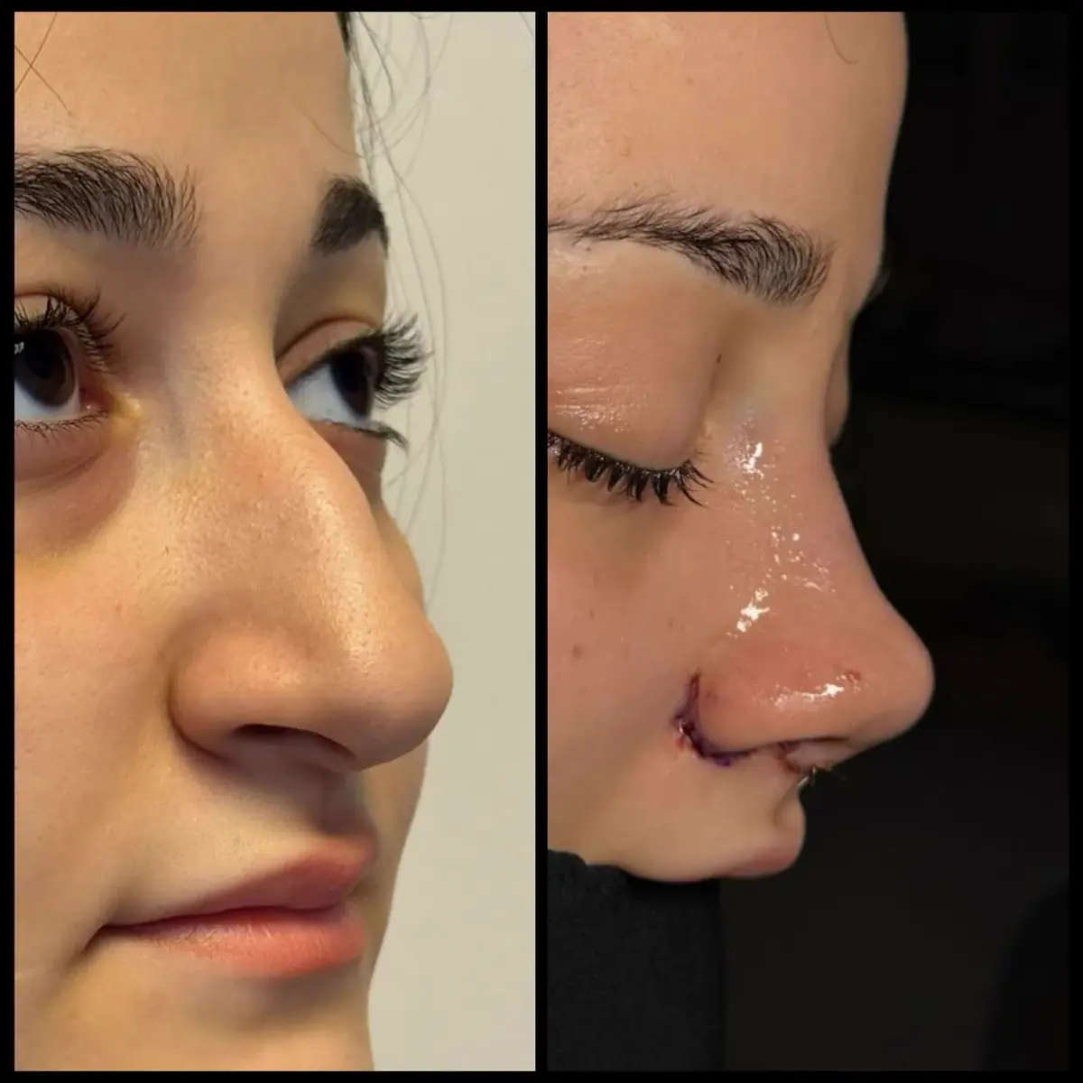 Rinoplasti öncesi · Fotoğraf 05