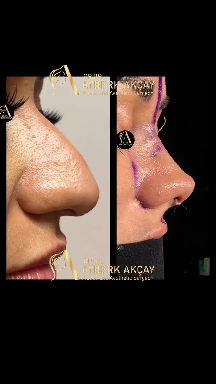Rinoplasti öncesi · Fotoğraf 02