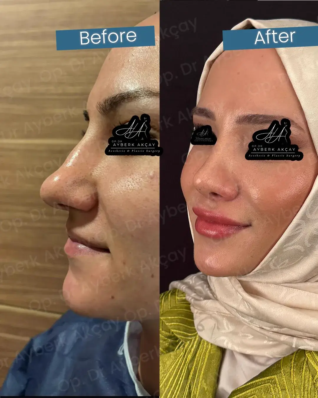 Dr. Ayberk Akçay - Gerçek Hasta Sonuçları